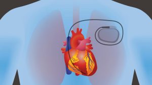 Personal Defib Vs Pacemaker Defibrillator vs Pacemaker: Comparison Guide for Heart Health | MDSI